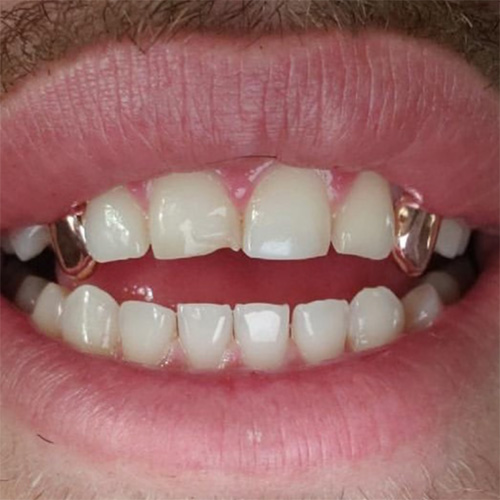 10K Solid Gold Top & Bottom Fangs – Grillz Pro